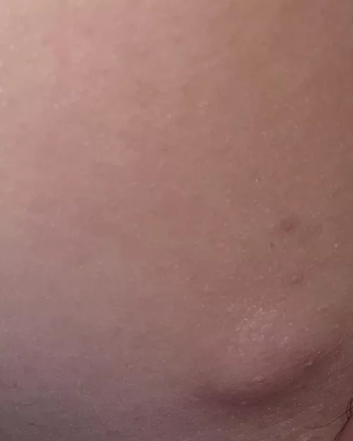 Any idea what this is? I’ve been to the doctor about two years ago and she said it felt okay. It’s got bigger since and hurts more. It’s on the inner side of my groin/leg.