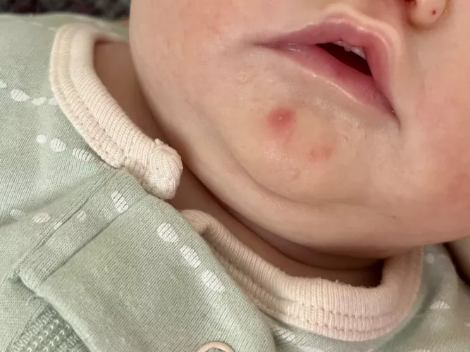 Baby acne: Forbidden pop