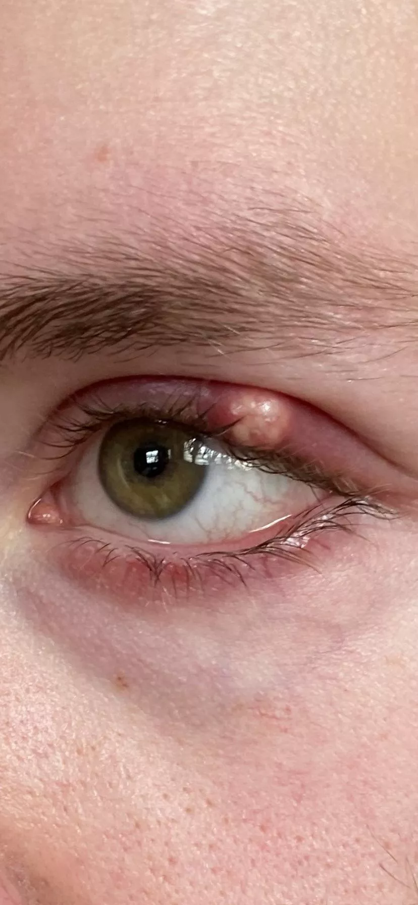 Biggest stye I’ve ever had I’m trying to fight the urge to drain it myself