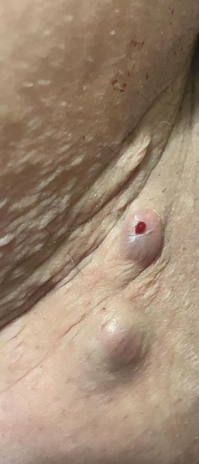 Boils on inner thigh/ butt area that I always get. They typically drain by themselves, super painful tho :/