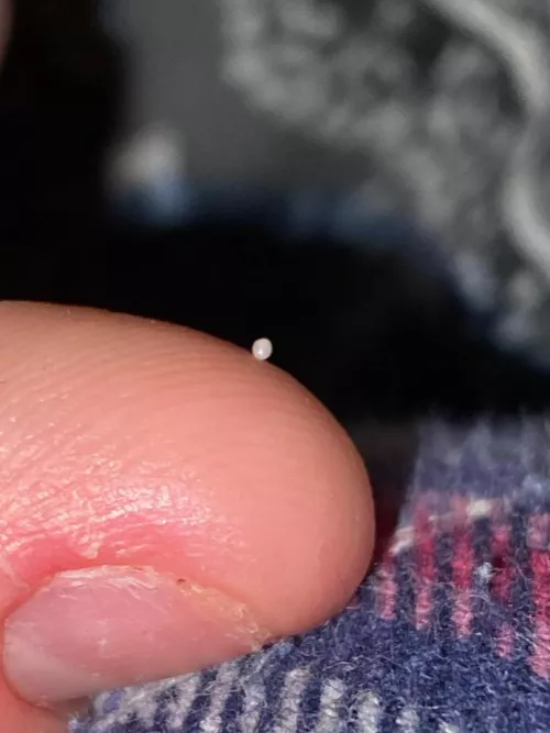 Does anyone know what this is? They keep showing up in my scars and i can pop them out of there. Are they cysts?