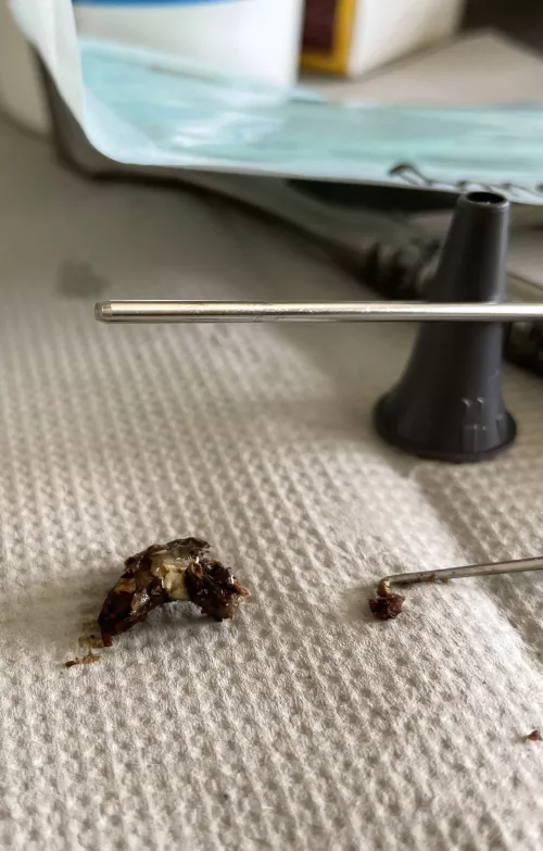 Extracted at the hospital. Now I can hear again.