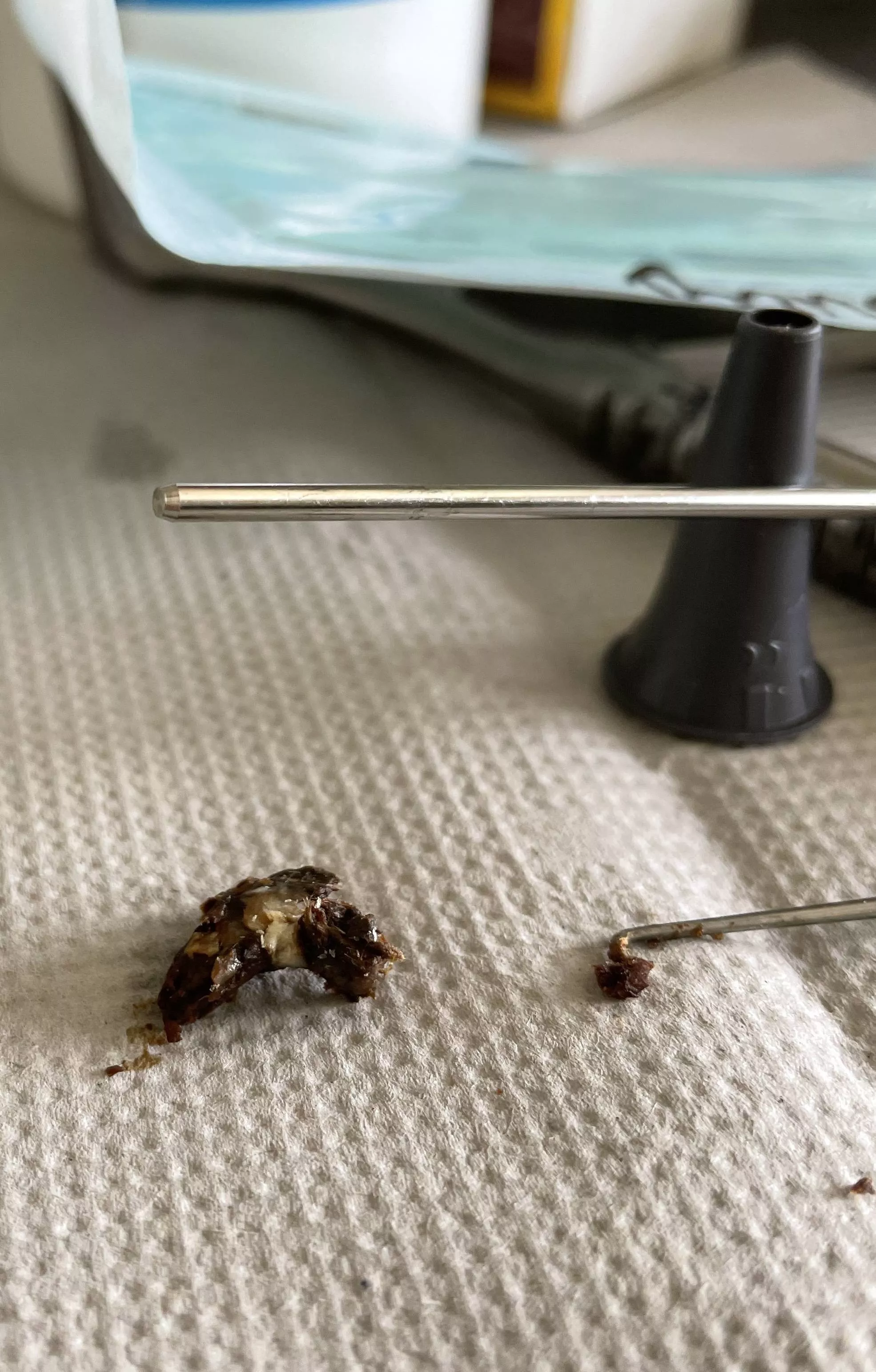 Extracted at the hospital. Now I can hear again.