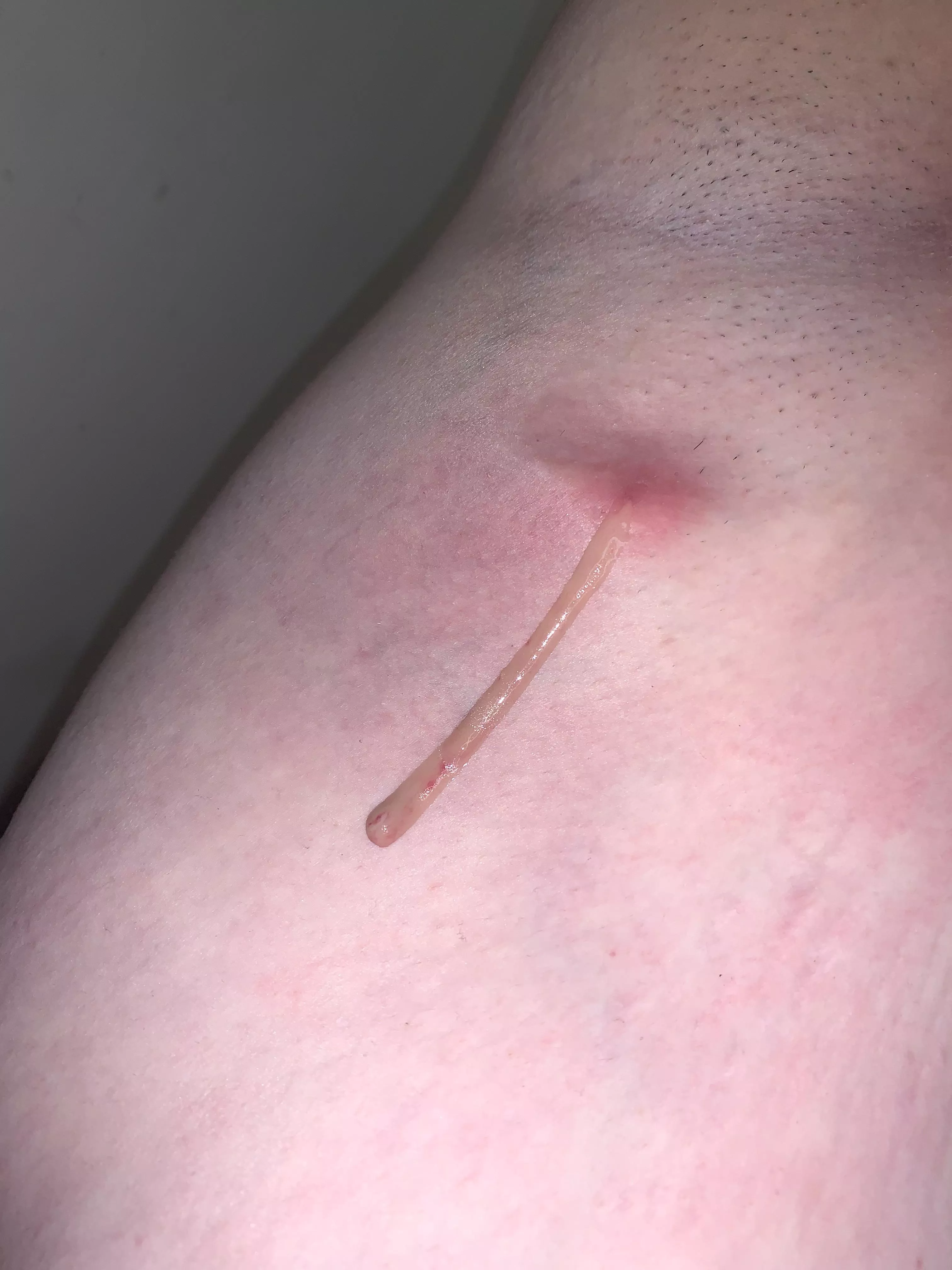 Finally some relief after four days of antibiotics