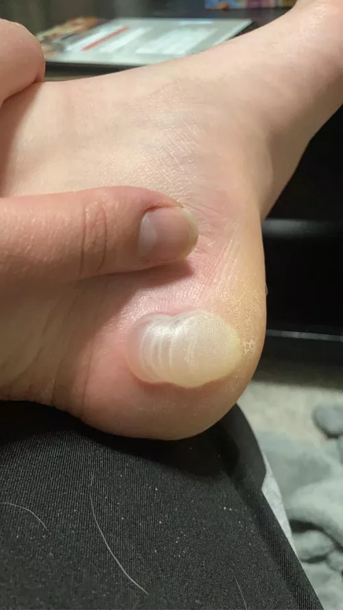 Here’s a blister? Not sure what to do about it. Over a week old and keeps getting bigger