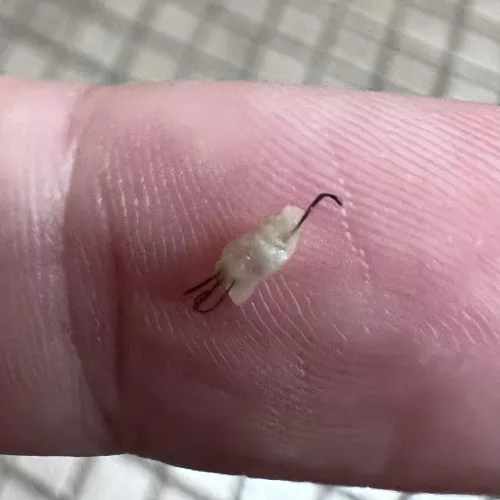 Ingrown pili multigemini 🤢