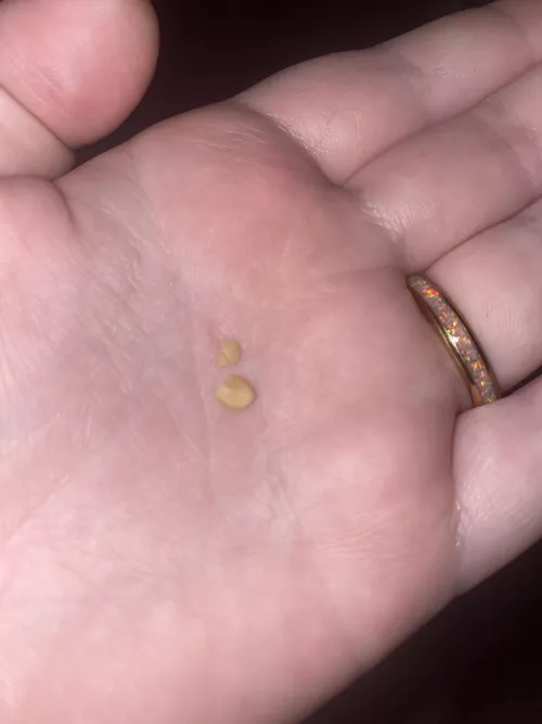 Just coughed up my first tonsil stone this is so weird