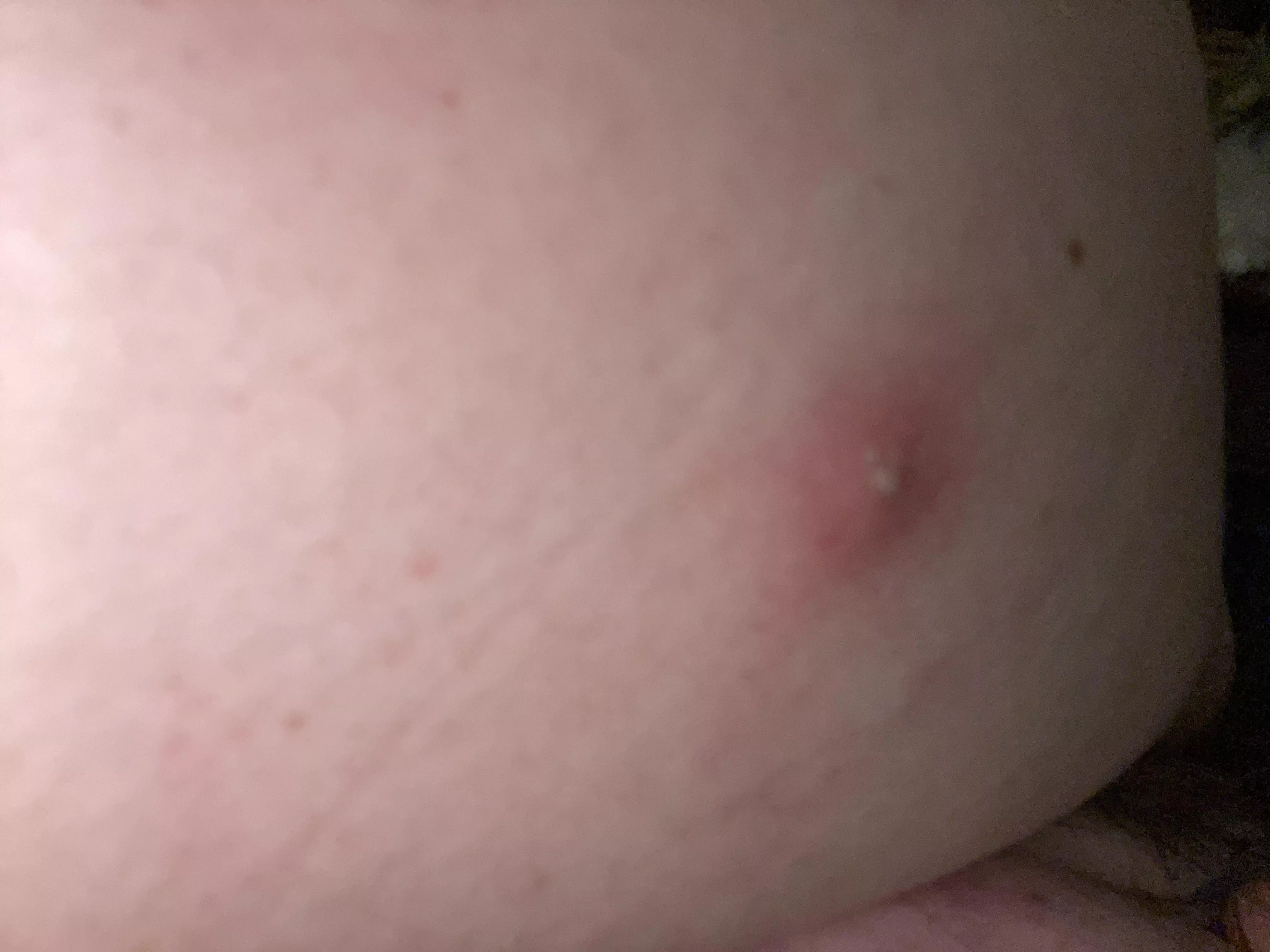 Massive bump on my back. Painful and it needs to go!