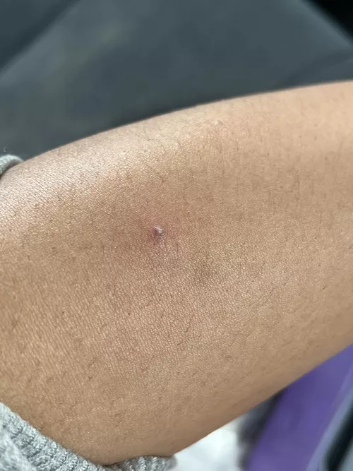 Pimple(?) on my arm. It won’t pop no matter what! Left it alone after a while because it got a bit bigger