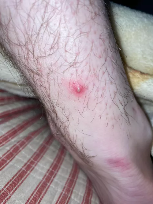 Pretty excited to rid this of my leg