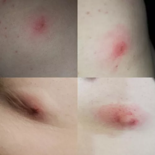 The progression of what I believe to be a spider bite on my side over just 24 hours. (yes I've seen a dr. )