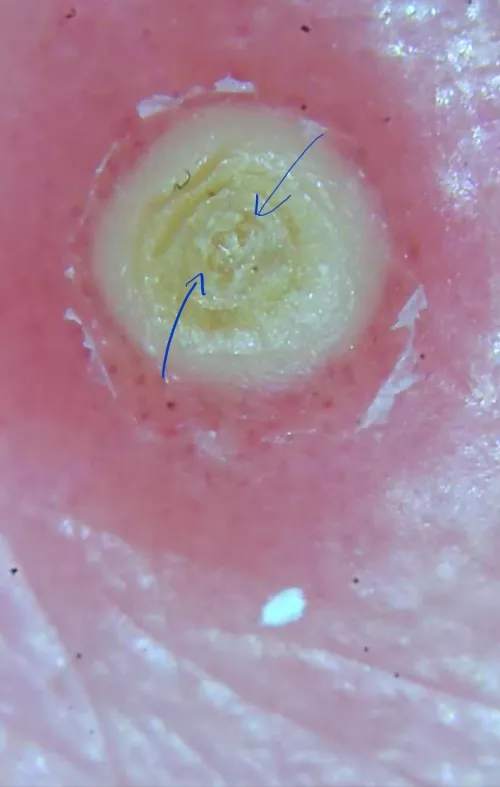 This is on my friends back, she's going to let me pop and video it (I'm doubtful it'll be anything exciting) I had a quick question thought... Does it look like seeds in the middle or am I losing my mind?