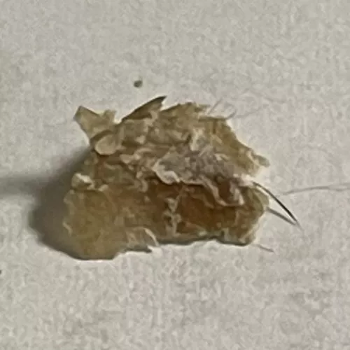 This isn’t a pop but it’s what I find once a month between my big toe and the one next to it! Dead skin and sebum mixture, with hair coming out of it! About the size of a dime. Fun, huh?!