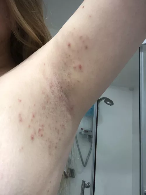 What is this? I keep getting reoccurring pimples above & below my armpits. The pimples themselves are sore, usually whiteheads but sometimes there’s deep larger ones too, it tends to last 2-3 weeks at a time & I don’t get pimples anywhere els