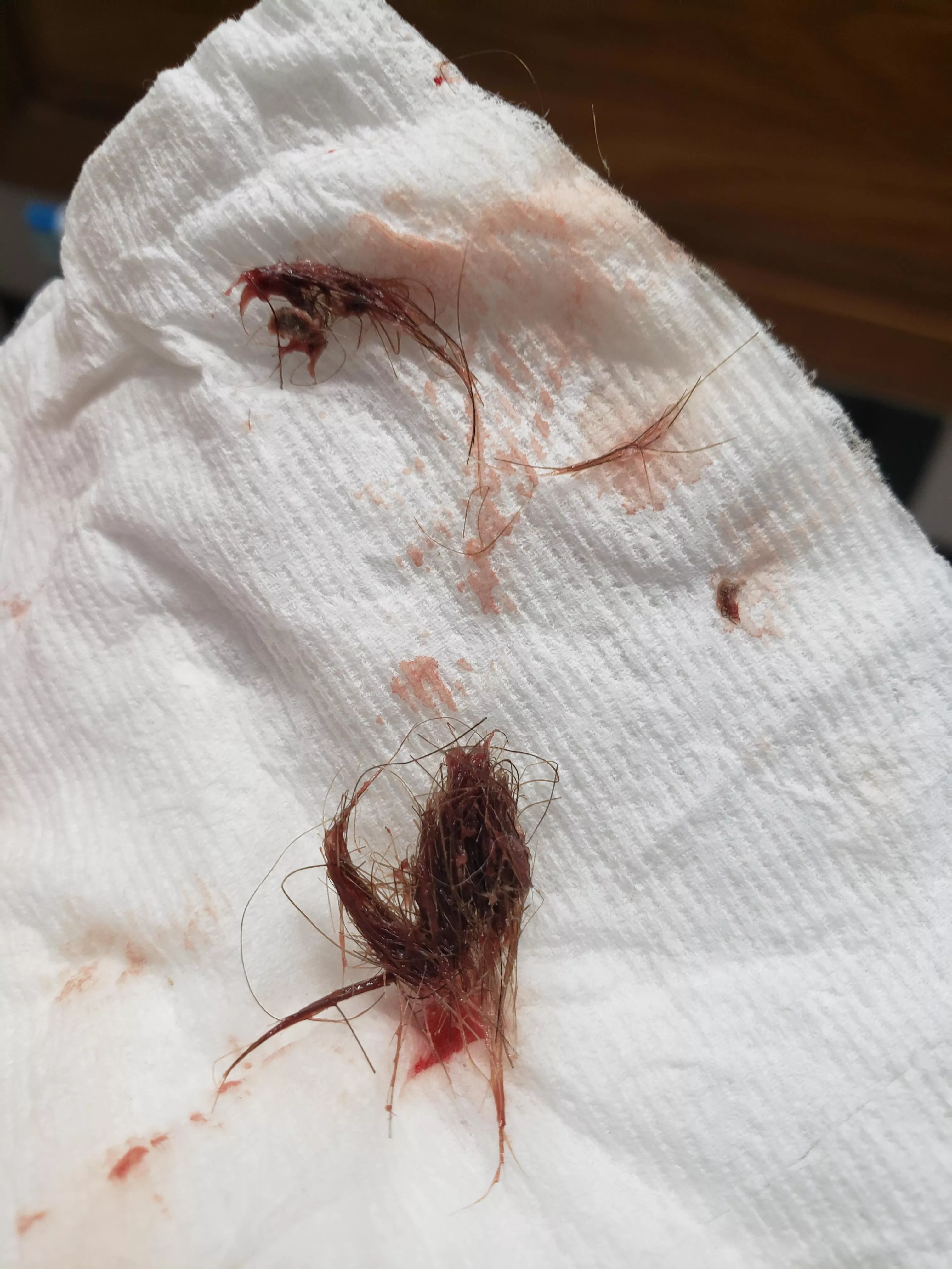 2 days ago my belly button began bleeding and had a slight discomfort sitting up and bending. It felt like it might have been a cyst. I put my finger in there and felt something, but couldn't quite reach it. Turns out it was a huge thing of hair? I've 2 days ago my belly button began bleeding and had a slight discomfort sitting up and bending. It felt like it might have been a cyst. I put my finger in there and felt something, but couldn't quite reach it. Turns out it was a huge thing of hair? I've