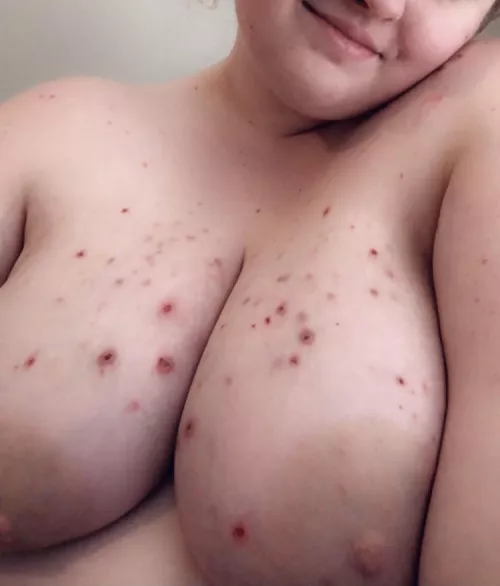 another attempt at being more confident despite my skin condition… here goes nothing😅