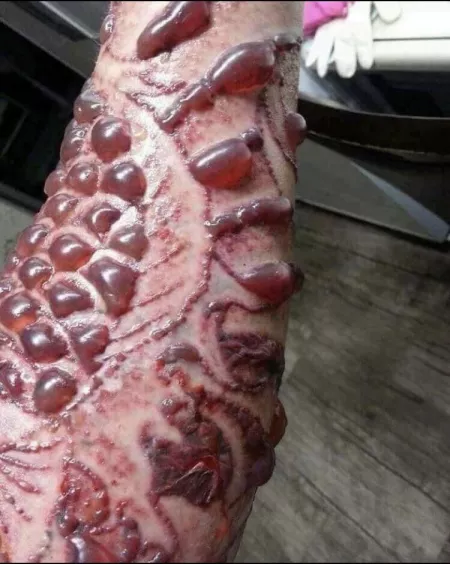 Blisters following laser treatment to remove tattoos. Not me, found in FB tattoo group.
