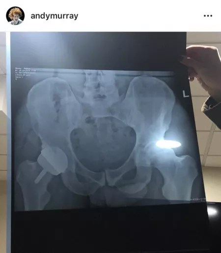 British/Scottish tennis player Andy Murray posted his hip X-ray to Instagram a while back. Little Andy is showing up 😂
