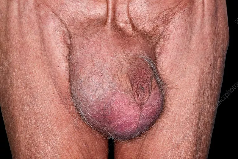 Bruised nutsack