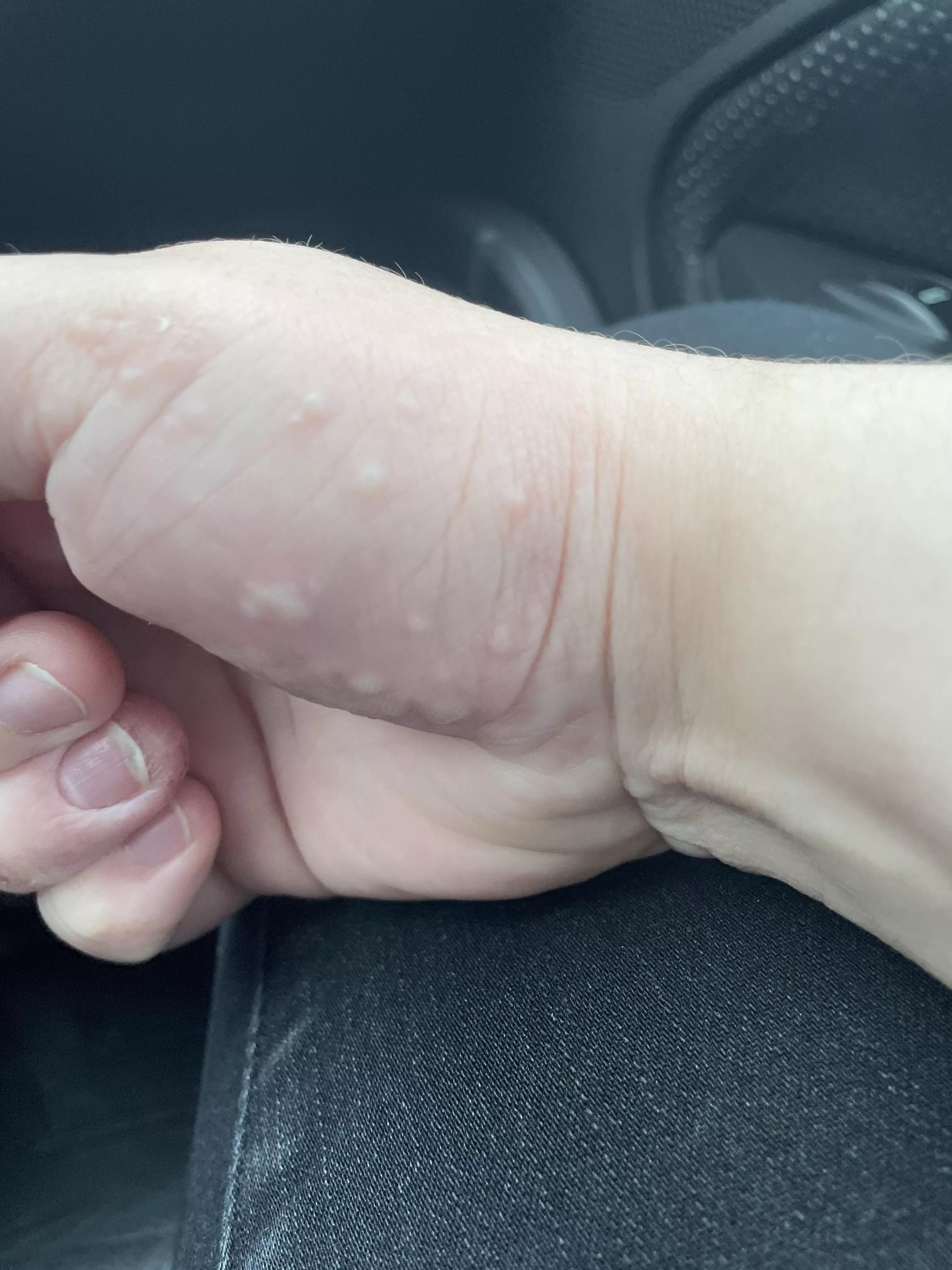 Contact dermatitis on my hand