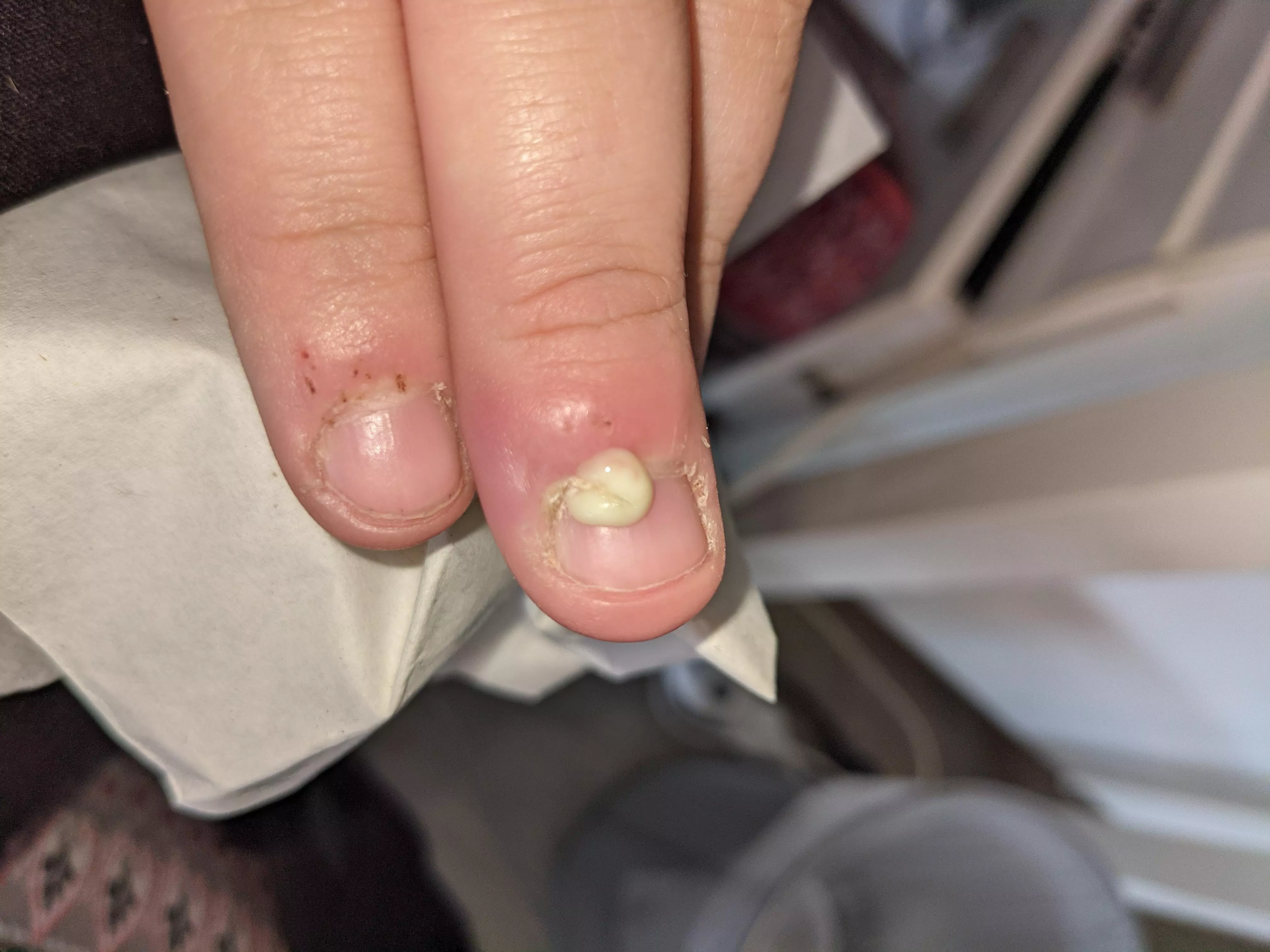 First submission! Post-pop of a cuticle infection (accidentally, would have recorded if I knew it would pop today) will provide update if more comes out later 😂