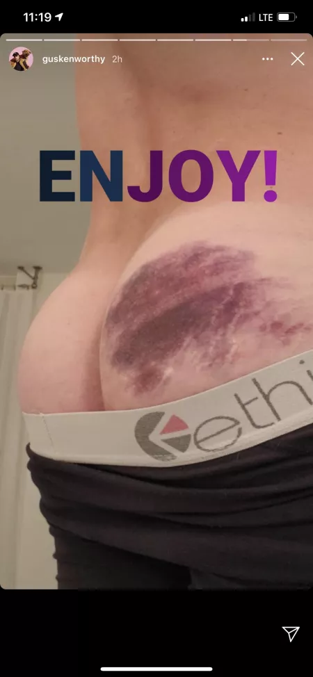 Gus Kensworthy via Instagram Story (Bruised Butt)