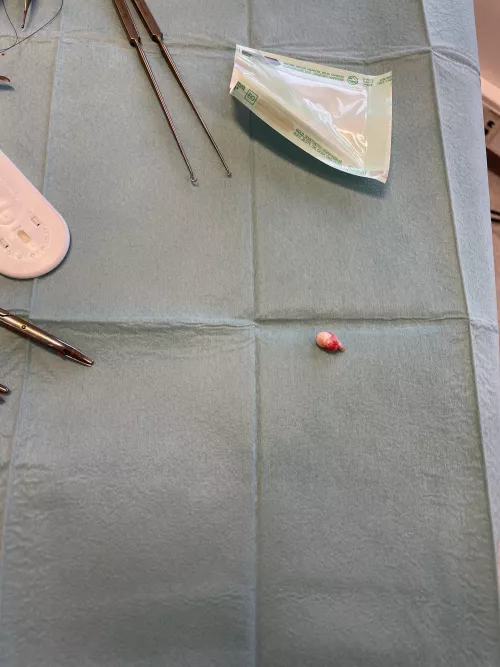 Had a cyst removed from my neck, they did squeeze it first. Sorry no video, but couldn’t bring anyone with me to film because of you know what.