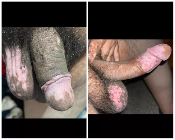 Here is my vitiligo grower