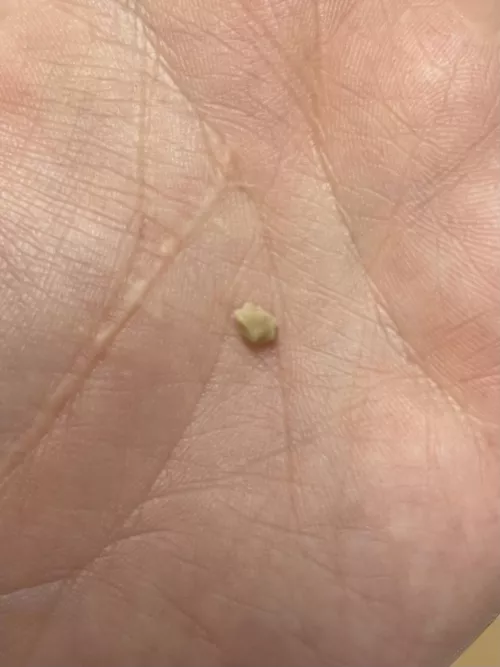 Long time lurker. Finally have something worth posting. Popped out this tonsil stone mid conversation.