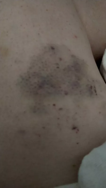 My beautiful bruise I gave myself on my left inner thigh, makes me wet to touch it My beautiful bruise I gave myself on my left inner thigh, makes me wet to touch it