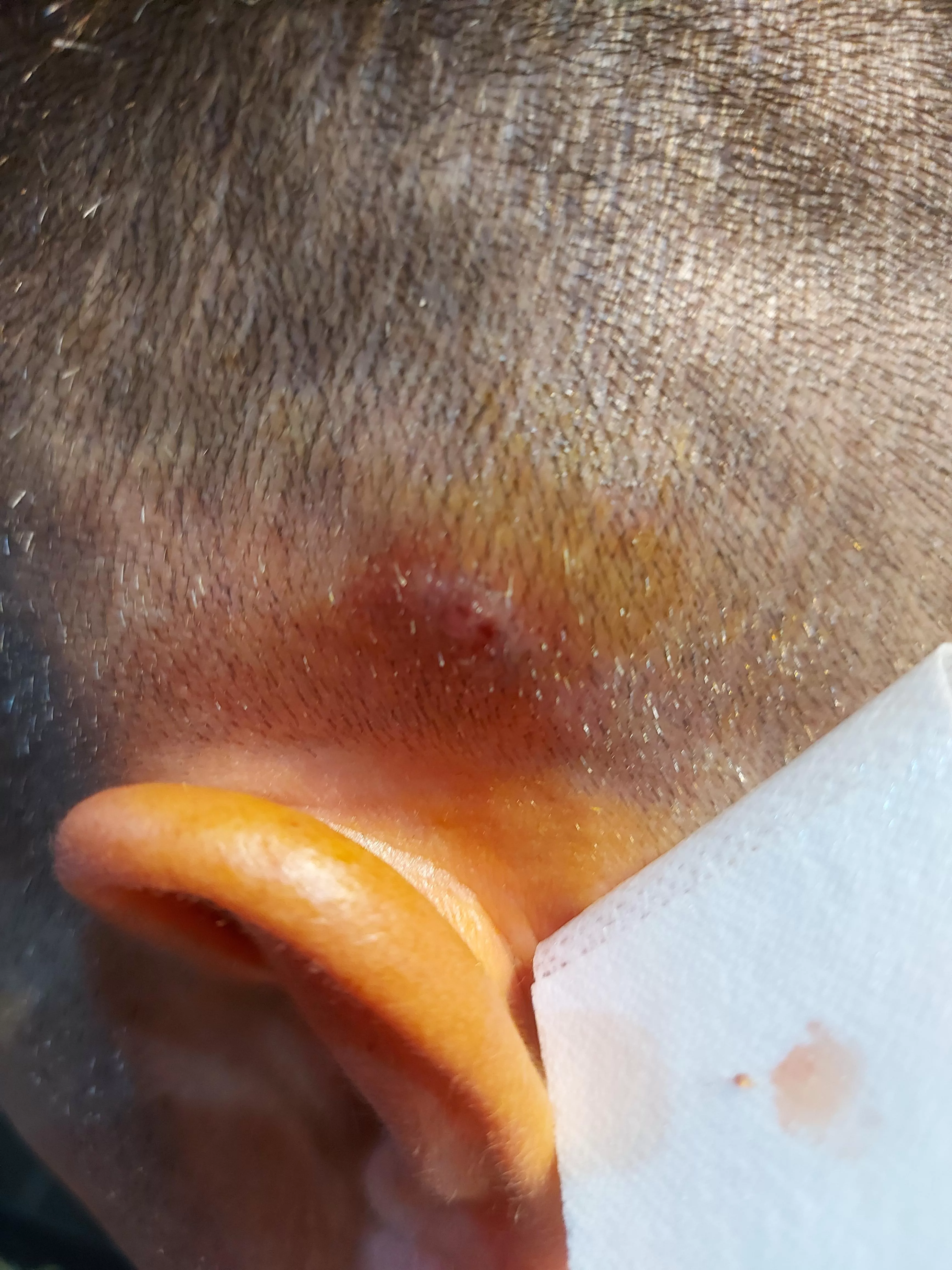 No idea what's that. Probably cyst or some kind of lipoma. Tried to squeeze it(with gloves ofc). But only blood and some brown pus came out. It's on my mother's boyfriend's side of head. He said that it just grew in a day. Cleaned with betadine and d No idea what's that. Probably cyst or some kind of lipoma. Tried to squeeze it(with gloves ofc). But only blood and some brown pus came out. It's on my mother's boyfriend's side of head. He said that it just grew in a day. Cleaned with betadine and d