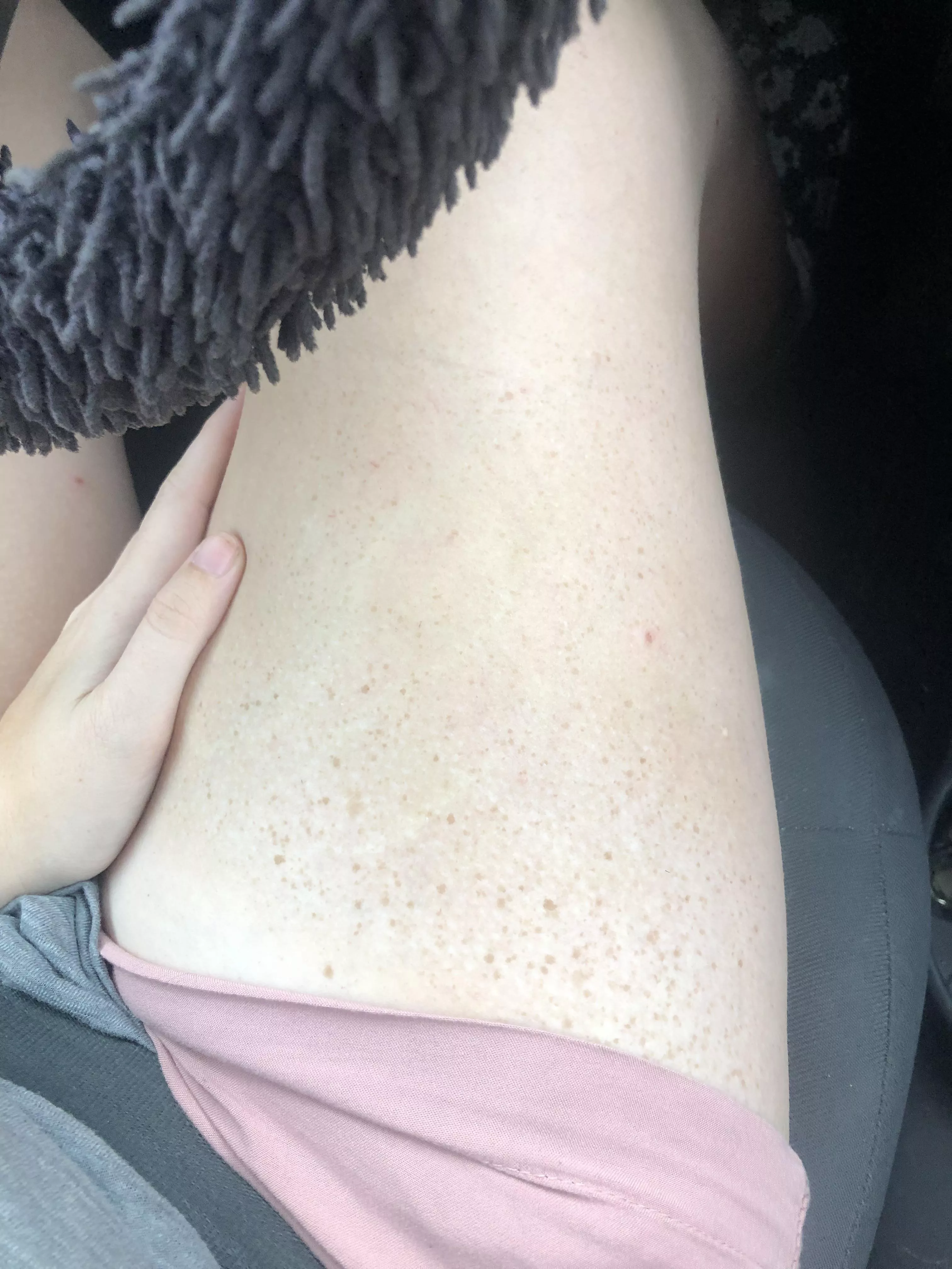 Summer freckles