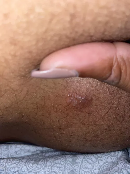 This is the 2nd time this popped up on my butt what is this. It itched but there was nothing there and like overnight it grew and has individual white heads